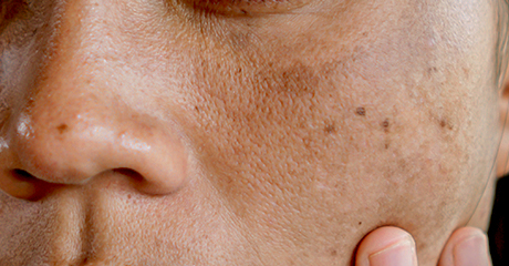 ฝ้า กระ จุดด่างดำ