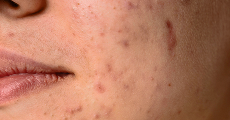 ปัญหาสิว