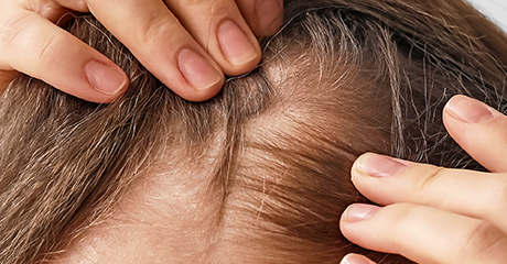 ผมร่วง ผมบาง